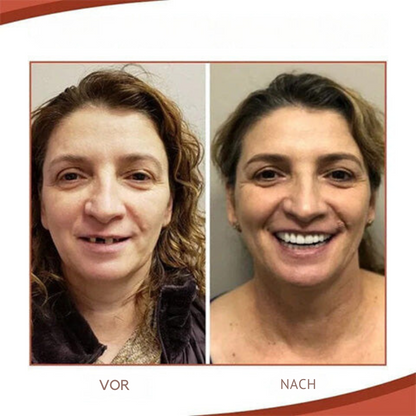 Biocompatible  Prosthesis Set for Pain-Free Fit and Natural Smile