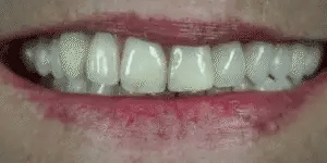 Snap-On Veneers Set for Upper &amp; Lower Teeth with Custom Fit | Removable Solution for a Natural-Looking Smile
