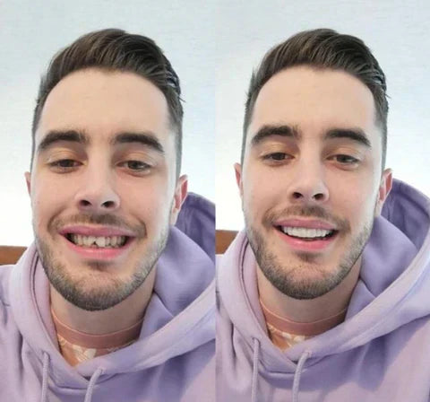 Snap-On Veneers Set for Upper &amp; Lower Teeth with Custom Fit | Removable Solution for a Natural-Looking Smile