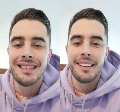 Snap-On Veneers Set for Upper &amp; Lower Teeth with Custom Fit | Removable Solution for a Natural-Looking Smile