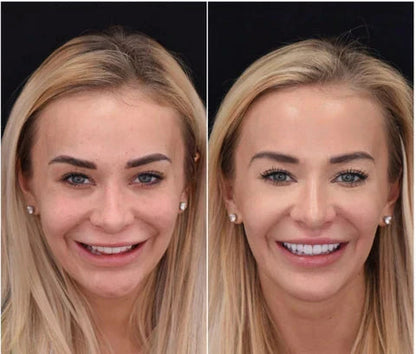 Snap-On Veneers Set for Upper &amp; Lower Teeth with Custom Fit | Removable Solution for a Natural-Looking Smile