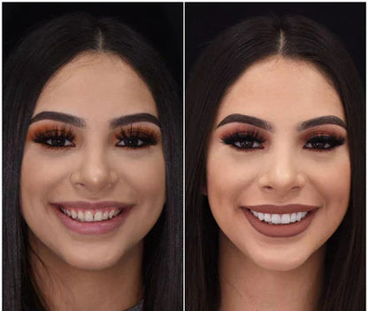 Snap-On Veneers Set for Upper &amp; Lower Teeth with Custom Fit | Removable Solution for a Natural-Looking Smile