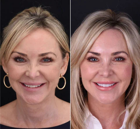 Snap-On Veneers Set for Upper &amp; Lower Teeth with Custom Fit | Removable Solution for a Natural-Looking Smile